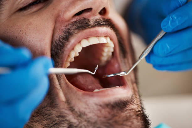 Best Emergency Wisdom Teeth Removal in Ofallon, IL